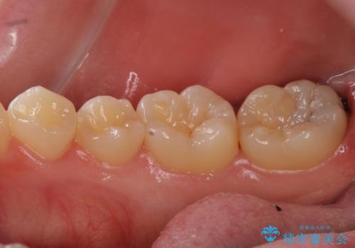 虫歯治療後、精度の良いゴールドアンレーへの治療前