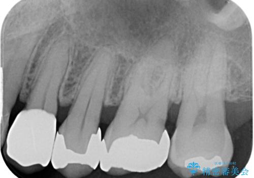 矯正が終わったのでセラミックに変えていきたい オールセラミッククラウンの治療後