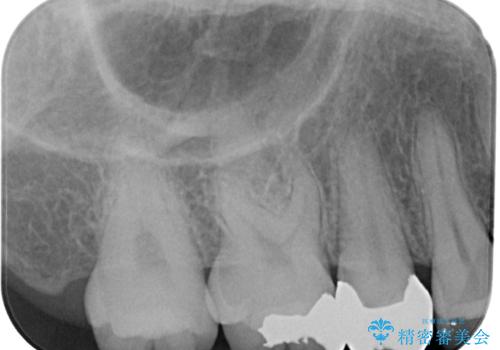右上の銀歯を外したい ハイブリッドインレー修復の治療前