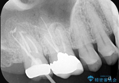 根尖性歯周炎|歯根嚢胞|インプラント治療の治療中