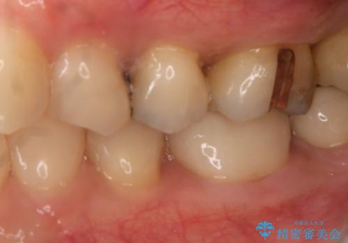 銀歯を白くしたい セラミックインレーの治療前