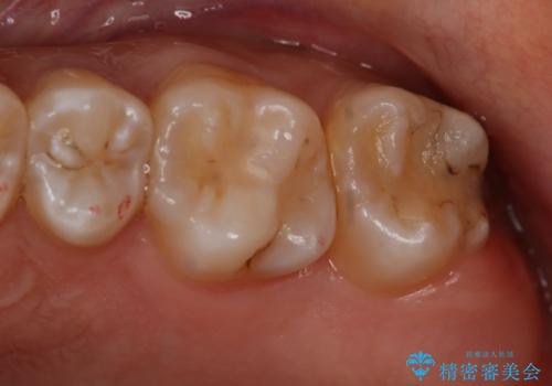 奥歯を治療したい　フルジルコニアクラウンの治療前