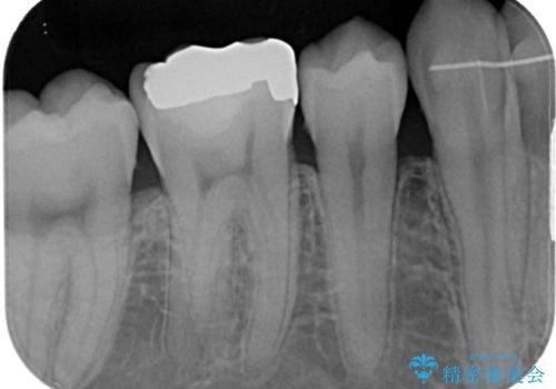 銀歯をセラミックにしたい オールセラミッククラウンの治療前