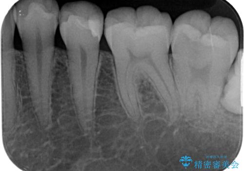 左下に虫歯が見つかった セラミックインレー修復の治療後