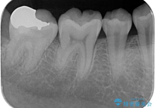 虫歯治療後、精度の良いゴールドアンレーへの治療後