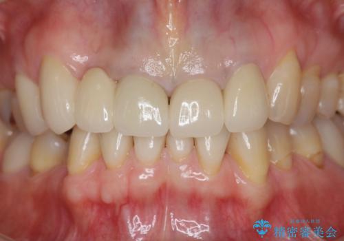 境目の見える前歯をきれいにしたい セラミック治療の治療後