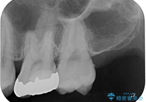 銀歯を外したい オールセラミッククラウンの治療前