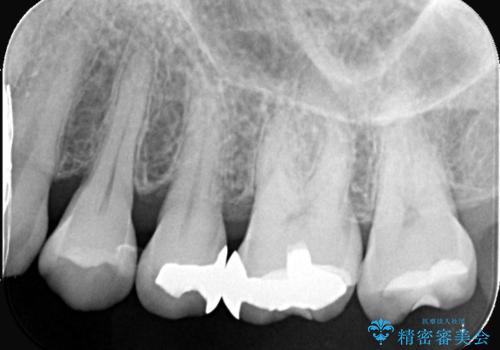 奥歯の銀歯を自然なセラミックに。安心のメタルフリー治療の治療前