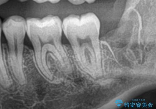 親知らずを抜きたい 親知らず抜歯の治療後
