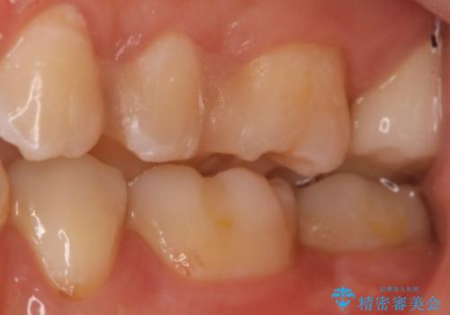 奥歯を治療したい　フルジルコニアクラウンの治療後