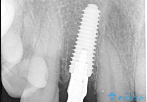 前歯の隙間とへこみが舌で触ると気になる|矯正治療は絶対にしたくない|抜歯即時インプラント+オールセラミッククラウンで審美修復の治療中