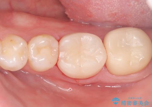 【歯牙移植】奥歯抜歯と言われたので親知らずを移植してほしいの治療後