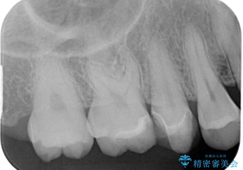 右上の銀歯を外したい ハイブリッドインレー修復の治療後