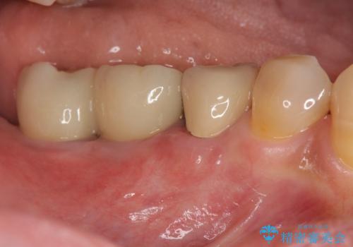 奥歯から膿のにおいがする インプラントによる機能回復の症例 治療後