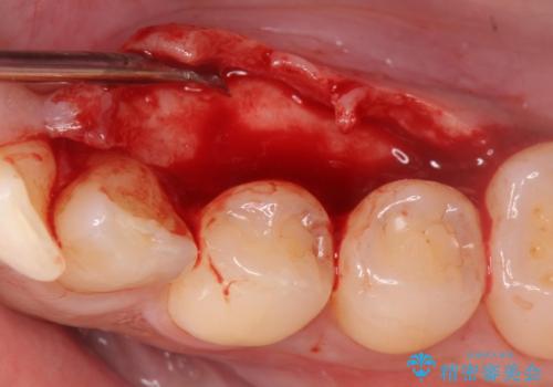 骨隆起を取りたいの治療前