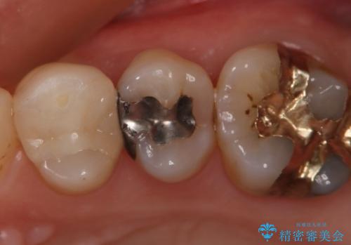 銀歯を白くしたい セラミックインレーの治療前