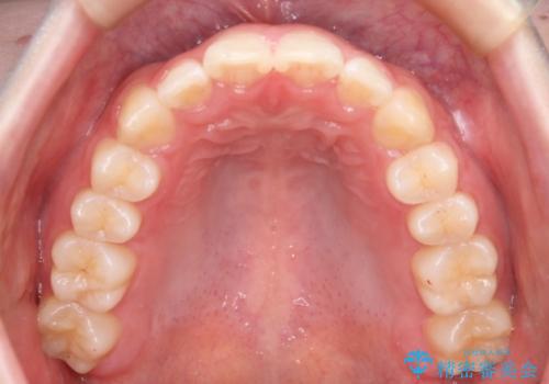 前歯のガタつきを治したい インビザライン・ライトパッケージの治療後