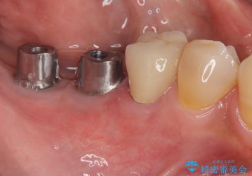 奥歯から膿のにおいがする インプラントによる機能回復の治療中