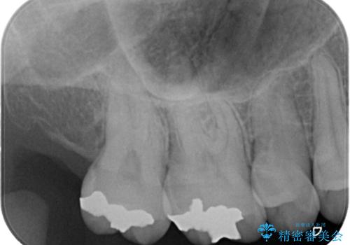 金属の被せ物を白くしたい【セラミックインレー】の治療前