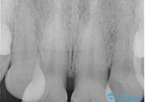 前歯の隙間とへこみが舌で触ると気になる|矯正治療は絶対にしたくない|抜歯即時インプラント+オールセラミッククラウンで審美修復の治療前