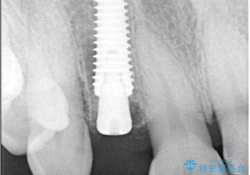 前歯の隙間とへこみが舌で触ると気になる|矯正治療は絶対にしたくない|抜歯即時インプラント+オールセラミッククラウンで審美修復の治療中