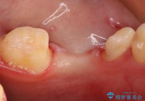 銀歯をやり変えたい フルジルコニアブリッジの治療中