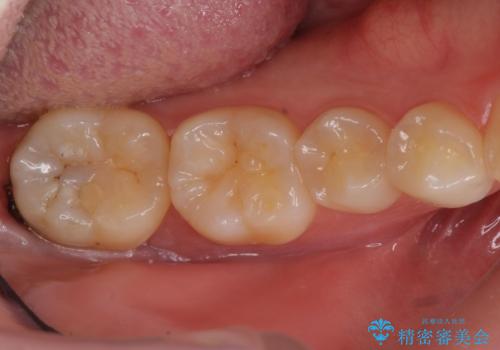 虫歯治療後、精度の良いゴールドアンレーへの治療前