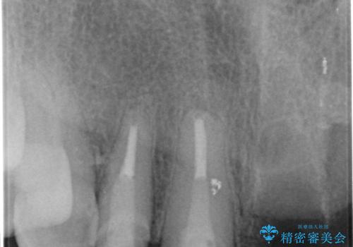歯槽堤保存術を併用したブリッジ治療の治療中