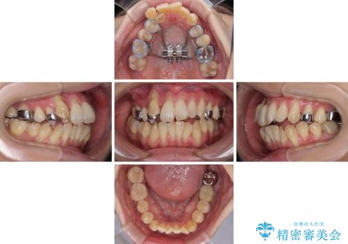 急速拡大装置 狭い骨幅を拡大した上で、顕著なデコボコを改善する抜歯矯正治療の治療中