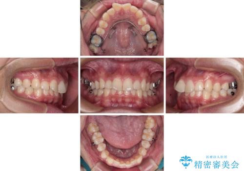 デコボコをインビザライン矯正で改善 奥歯は補助装置で確実に移動をの治療中
