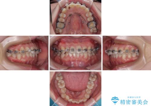 捻転の強い前歯 ワイヤー装置での非抜歯矯正の治療中