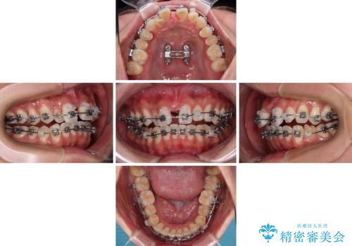 急速拡大装置 狭い歯列を拡大してクロスバイトを短期間矯正治療の治療中