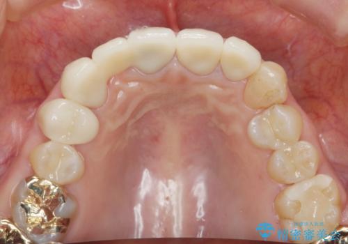 境目の見える前歯をきれいにしたい　セラミック治療の治療後