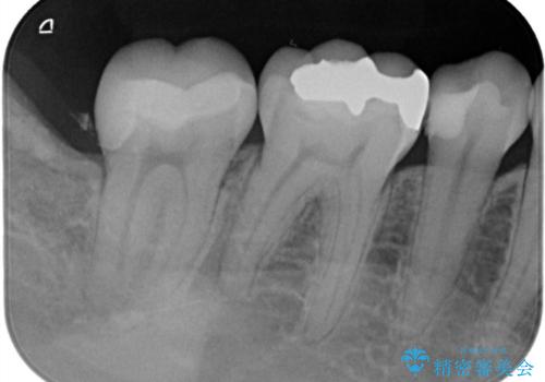 奥歯の銀歯を自然に!右下6番のメタルフリー治療の治療前