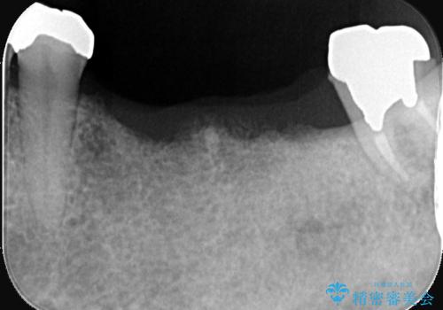 合わない入れ歯から卒業!奥歯2本をインプラントで快適にの治療前