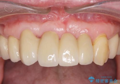 叢生(でこぼこ・八重歯)の症例 治療後