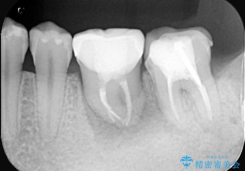 【歯牙移植】奥歯抜歯と言われたので親知らずを移植してほしいの治療後