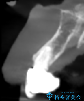 歯茎の腫れが気になる方必見!|抜歯即時インプラントで前歯5本を痛みなく3か月で治療完了!の治療中