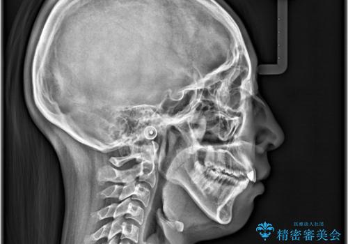 軽度の歯のデコボコ(叢生)をインビザライン(マウスピース)で改善|わずか5か月で整った歯並びにの治療後