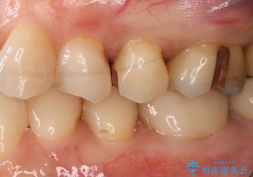 銀歯を白くしたい セラミックインレーの治療中