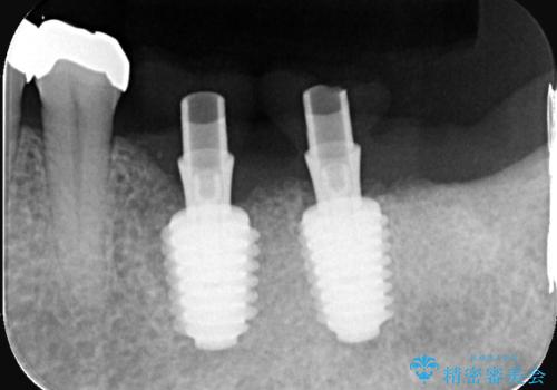 合わない入れ歯から卒業!奥歯2本をインプラントで快適にの治療中