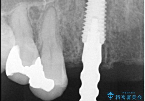 歯茎の腫れが気になる方必見!|抜歯即時インプラントで前歯5本を痛みなく3か月で治療完了!の治療中