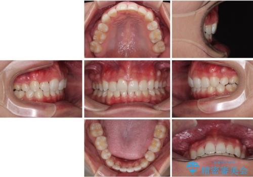 前歯のデコボコと正中のずれを改善!白い装置で目立たない矯正の治療後