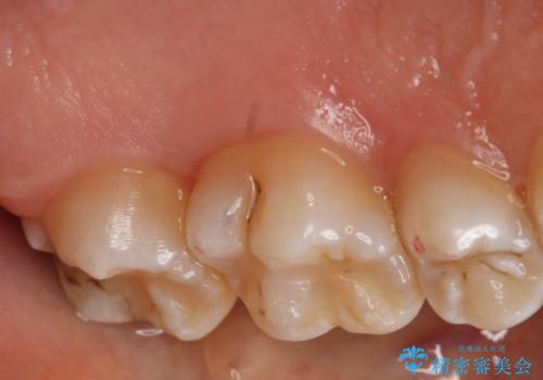 奥歯を治療したい フルジルコニアクラウンの治療前