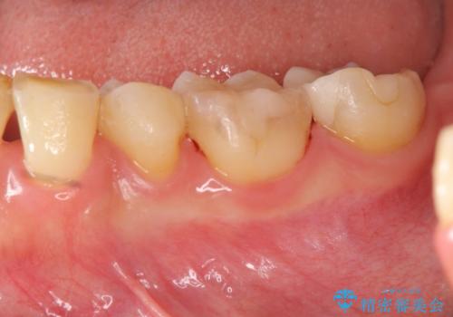 銀歯の下で虫歯の再発 拡大鏡下で行う虫歯の精密治療の治療後