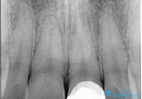 サーフィンで前歯をぶつけて歯が欠けた|かかりつけ医で治療困難と言われ当院へ来院|VPT(生活歯髄療法)で神経を保存|前歯の見た目も改善の治療後