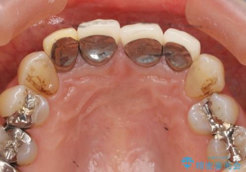 境目の見える前歯をきれいにしたい セラミック治療の治療前