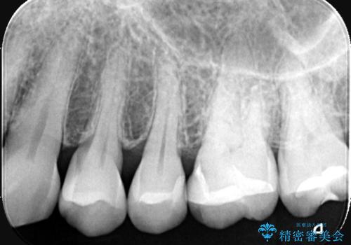 奥歯の銀歯を自然なセラミックに。安心のメタルフリー治療の治療後