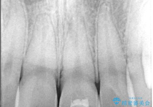 サーフィンで前歯をぶつけて歯が欠けた|かかりつけ医で治療困難と言われ当院へ来院|VPT(生活歯髄療法)で神経を保存|前歯の見た目も改善の治療中