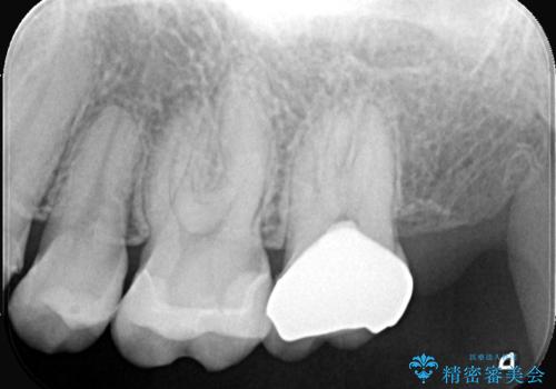 虫歯を治したい〈セラミック〉の治療後